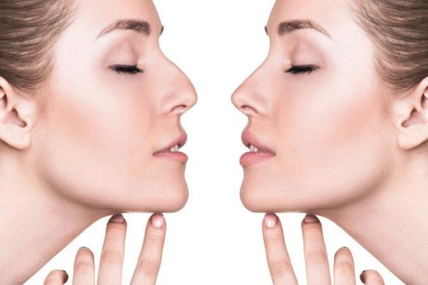 Ринопластика - коррекция формы носа
