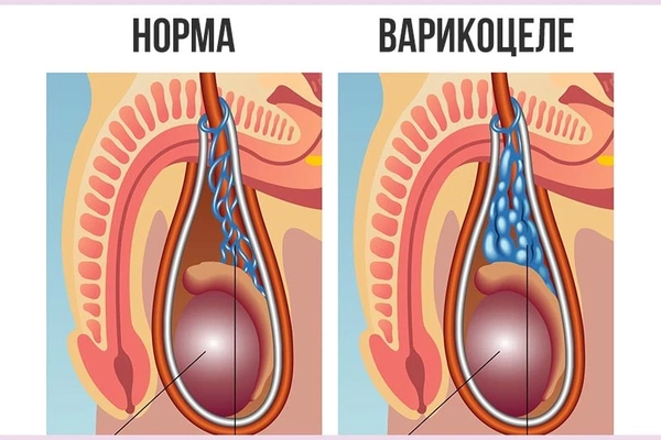 Операция варикоцеле - проявления и лечение