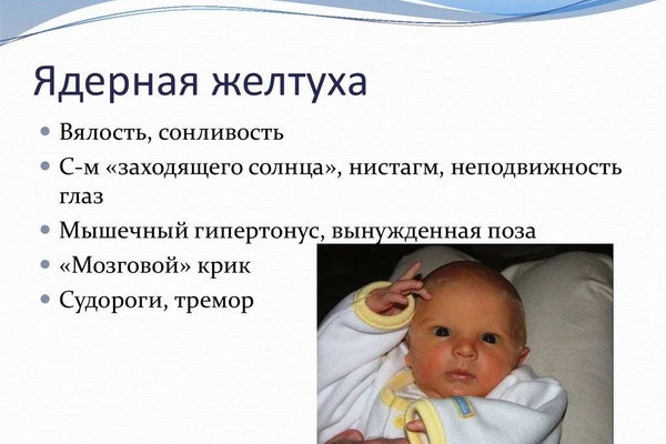 Желтуха: что это, симптомы и лечение в новорожденных и взрослых Желтушка у новорожденных