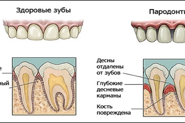 Опасный пародонтит - что нужно знать