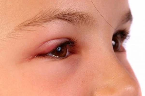 Сыпь вокруг глаз - ее причины и лечение