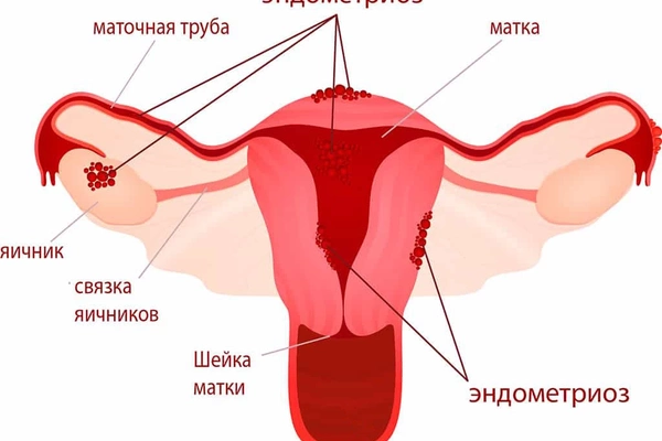 Эндометриоз - что это такое, как с этим жить, можно ли вылечить