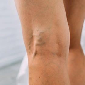 Второе мнение врача флеболога за 1 рубль