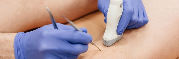 Минифлебэктомия