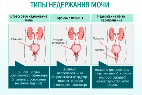 Недержания мочи - какие причины и решения проблемы