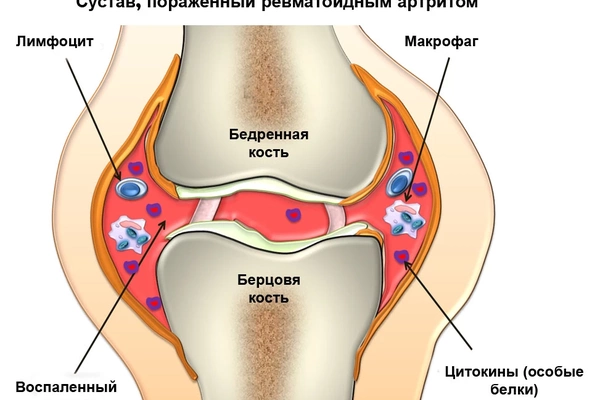 Диета при полиартрите суставов особенности и рекомендации