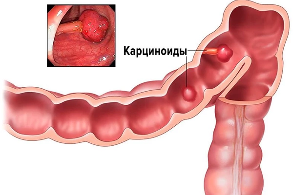 Карциноид: что это такое, диагностика, лечение