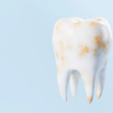 Зубной камень: просто налёт или уже проблема с зубами?