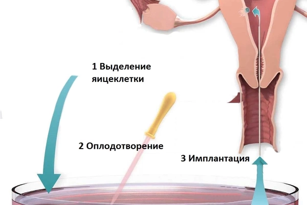 Экстракорпоральное оплодотворение - что такое ЭКО