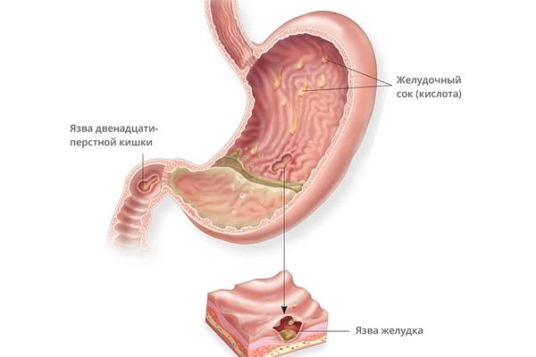 Лечение язвы желудка
