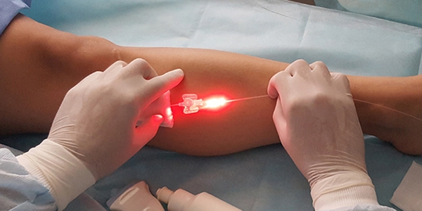 Эндовенозная лазерная коагуляция вен (ЭВЛК)