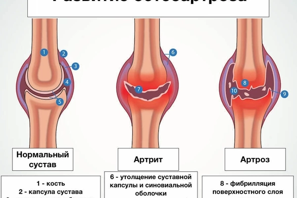 Дегенерация коленного сустава