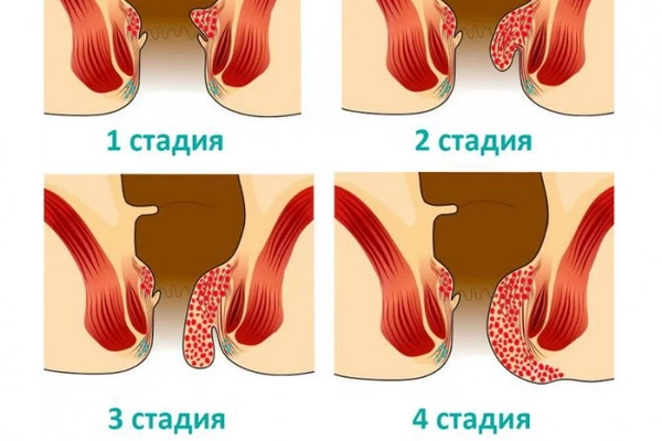 Какие симптомы геморроя и как его лечить