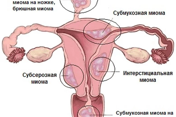 Как вылечить миому матки